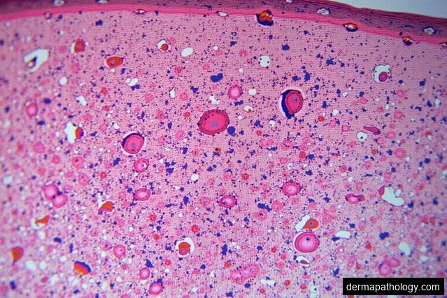 Advances in Digital Pathology for Skin Lesions